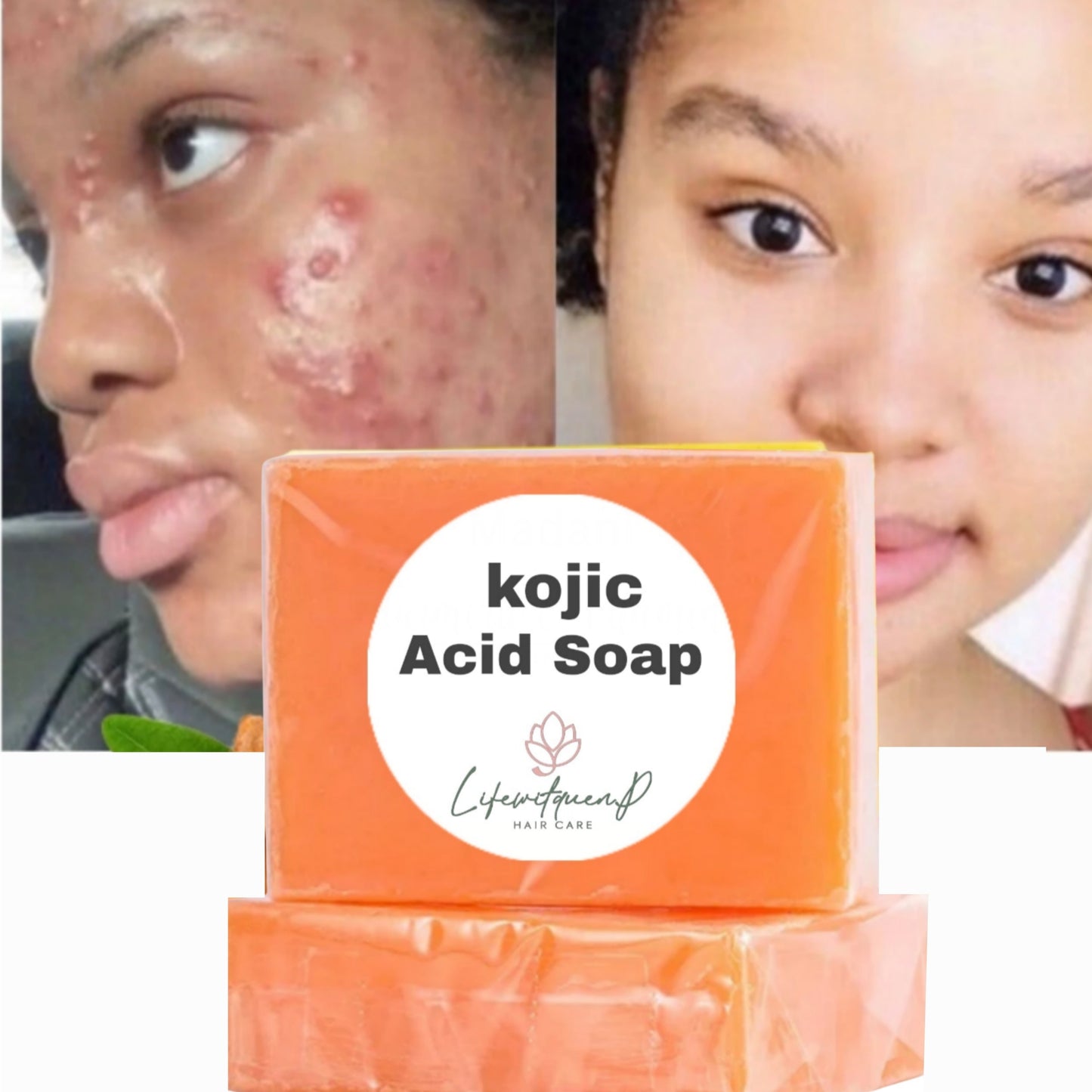 Kojie Acid Soap